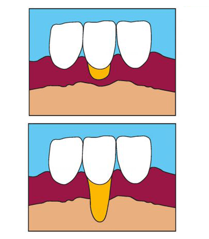 Zahnfleischrückgang behandeln