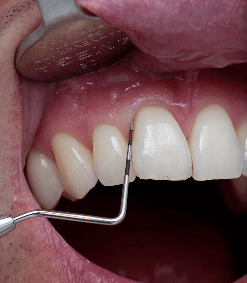 Unterstützende Parodontitis-Therapie (UPT)